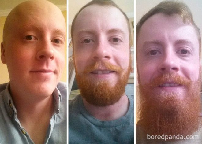 An Update On My Beard. 10 Months Cancer Free