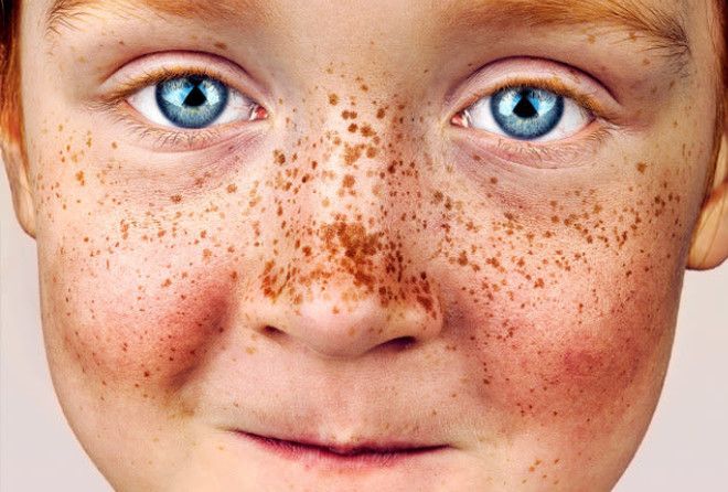 Freckles are gorgeous, and these photos show them in all their glory and variety
